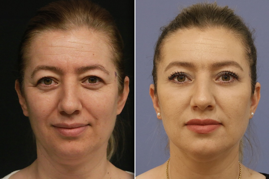 Under-Eye Light Filler