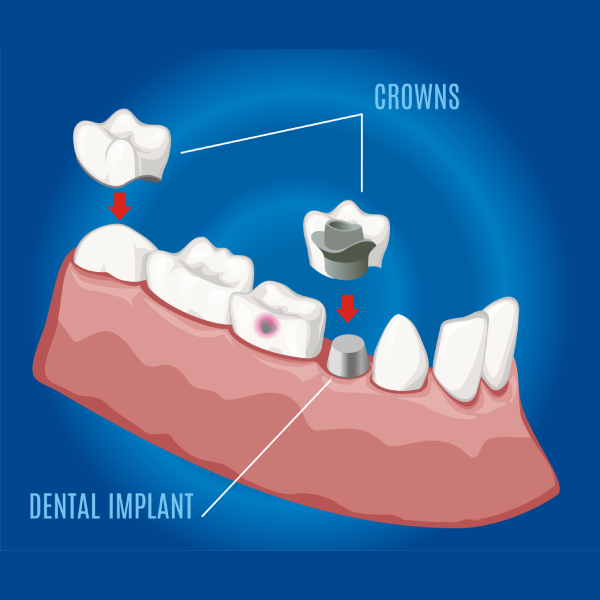 Zirconium Crown