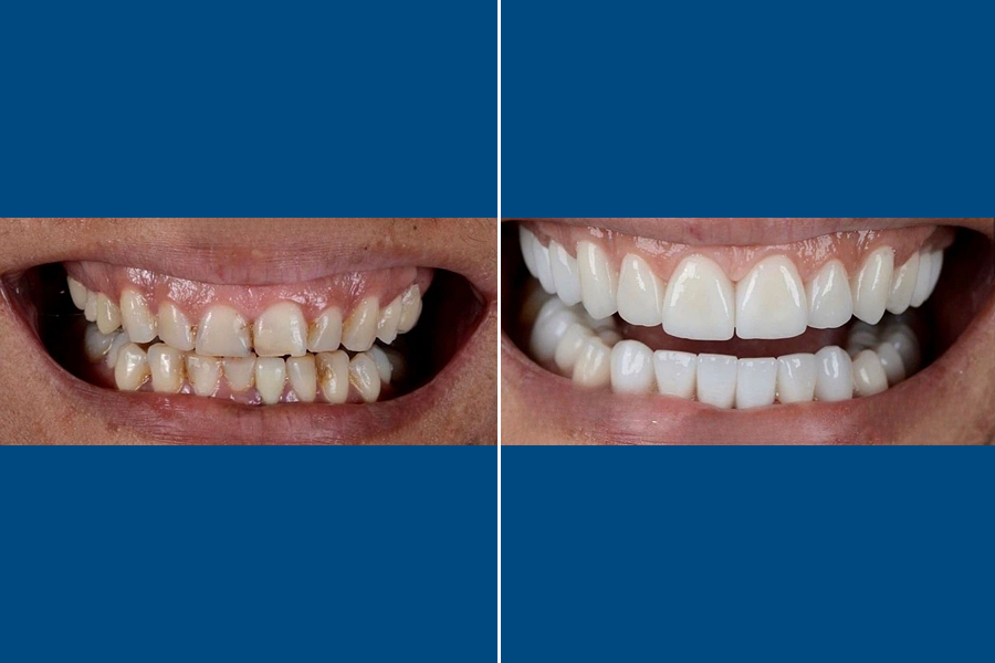 Zirconium Crown 2